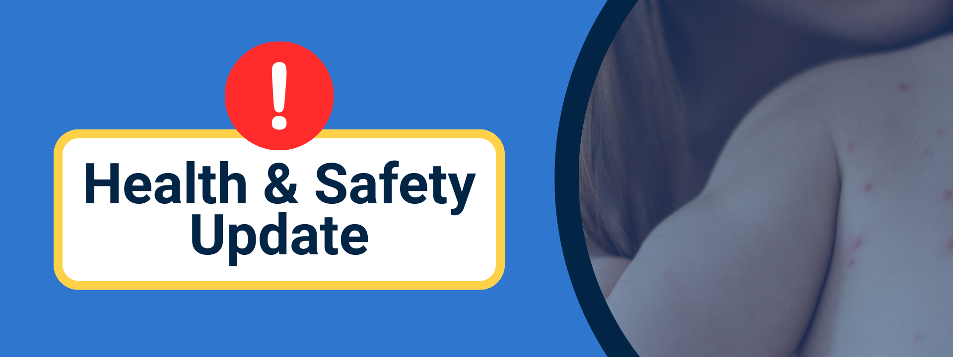 A blue background with a text box that says Health & Safety Update, with an image in a circle to the right side of a mother holding a baby with measles on their back.
