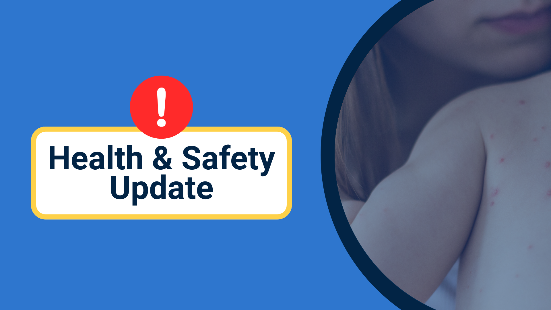 A blue background with a text box that says Health & Safety Update, with an image in a circle to the right side of a mother holding a baby with measles on their back.